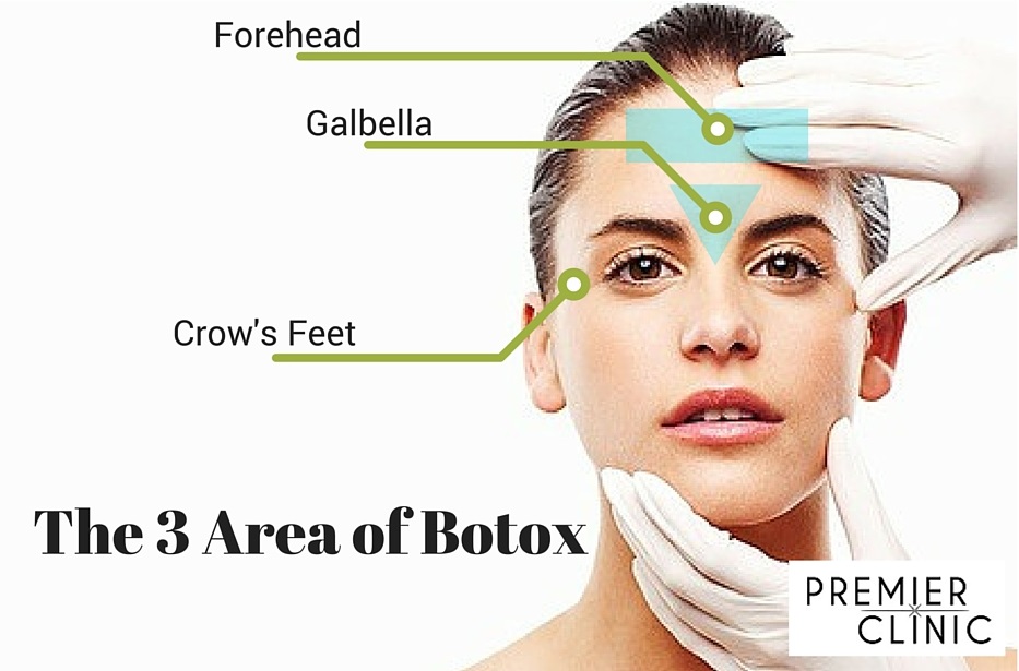 Areas for botox injections