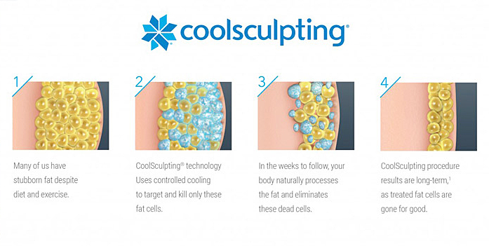 coolsculpting procedure