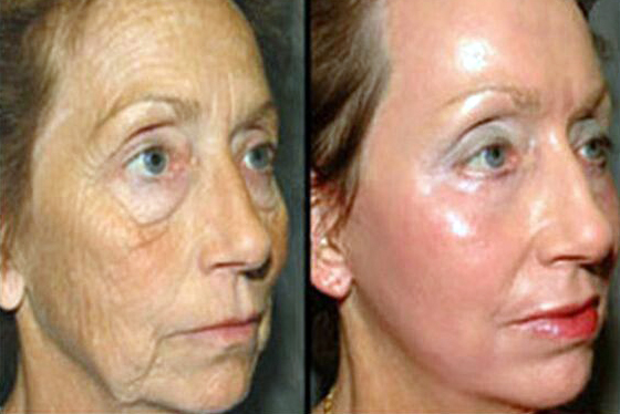 stem cell therapy for dull complexion