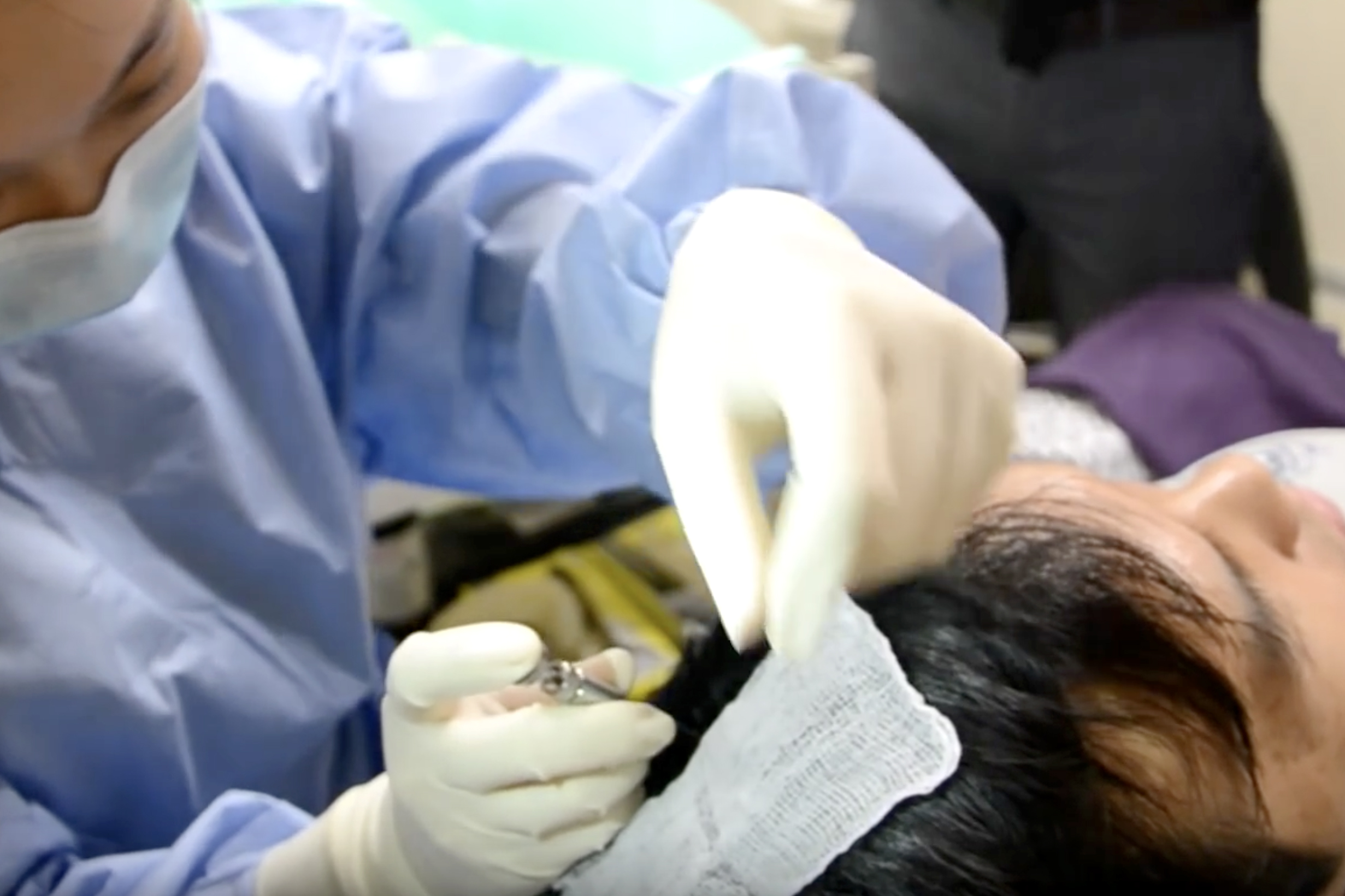 Biofibre Hair Implant 01 Premier Clinic (CN)