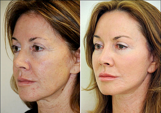 stem cell treatment for complexion