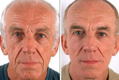 stem cell therapy for facelift