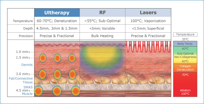 ultherapy chart