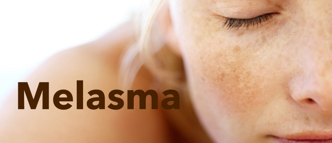 Melasma