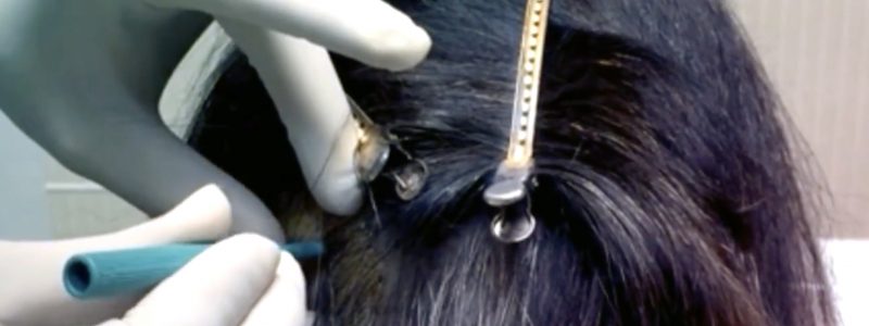 Stem Cell Hair Treatment 01