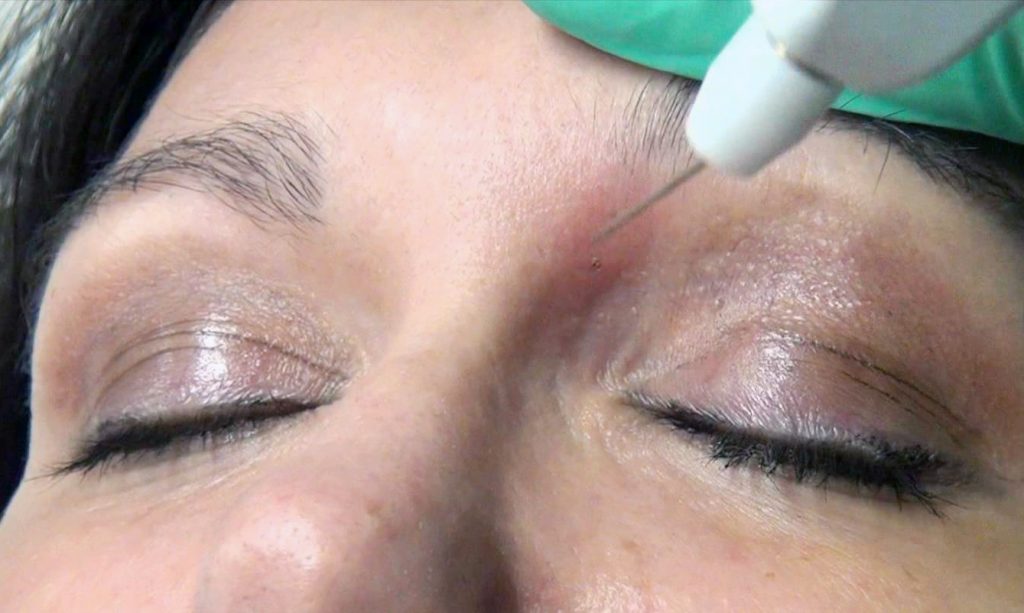 Plexr plasma soft surgery procedure
