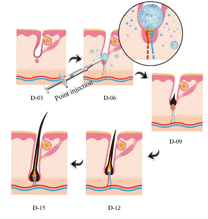 Intradermal Injection Prevent Hair Loss