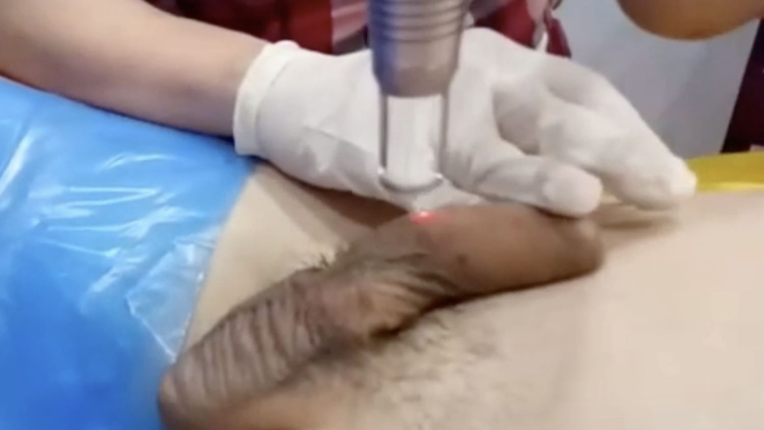 The laser treatment used for penis lightening is known to be very safe and ...