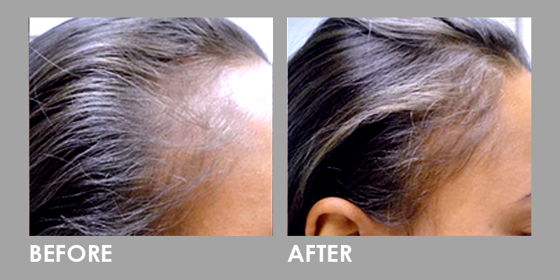 LED Photomodulation Therapy Hair Loss