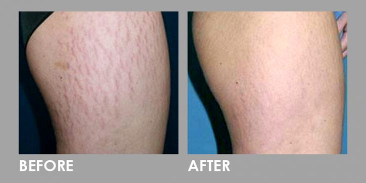 Fractional Co2 Laser For Stretch Mark Treatment Premier Clinic