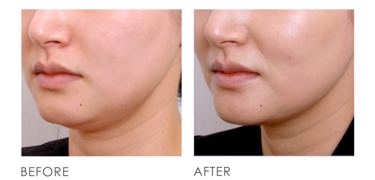 34++ Ultherapy vorher nachher bilder , Ultherapy Before After 04 Premier Clinic (CN)