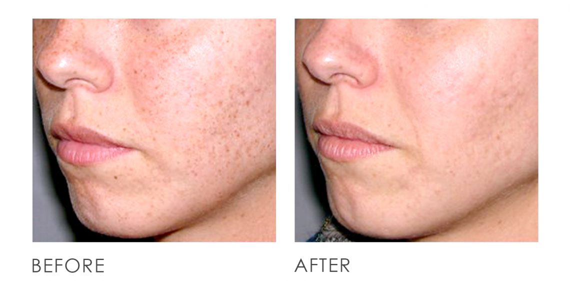 destroy-spots-pigmentation