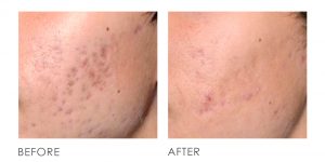 pigmentation q switch laser