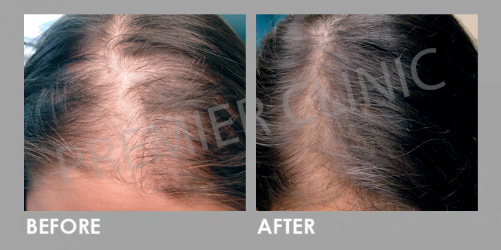 Premier Clinic FUE Hair Transplant Before After