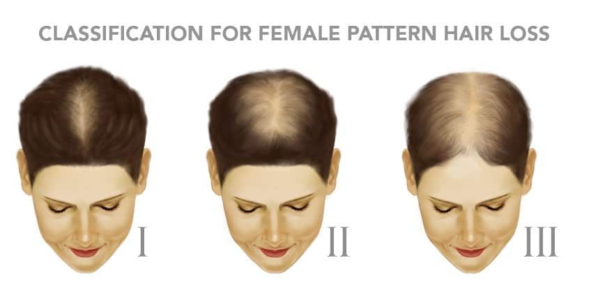 Woman-hair-loss-Classification