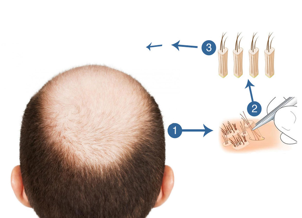 Premier Clinic performs FUE Hair Transplant