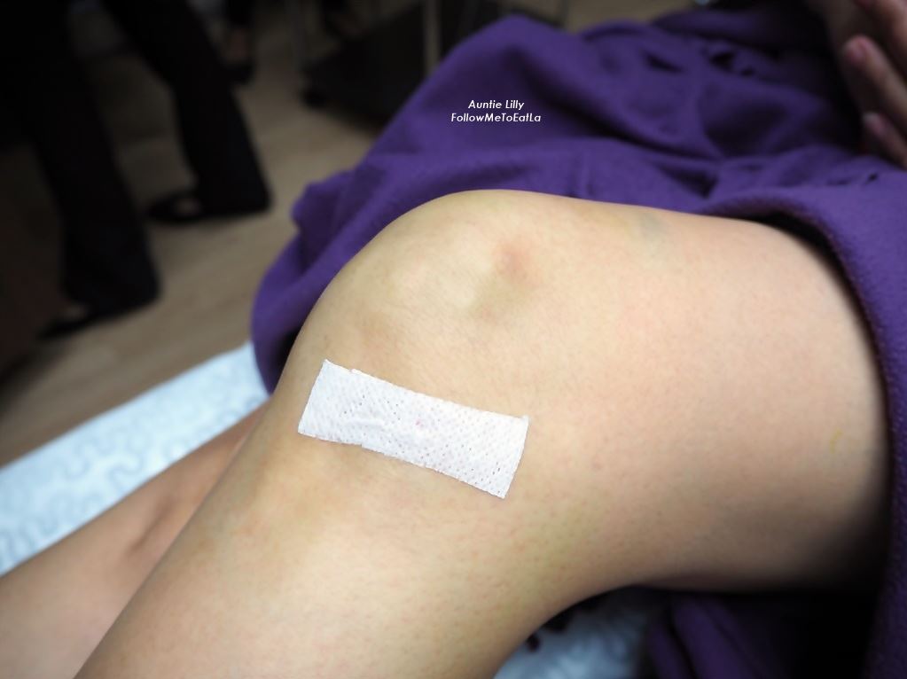 after knee prp injection