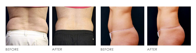 HCG Fat Loss Treatment before after