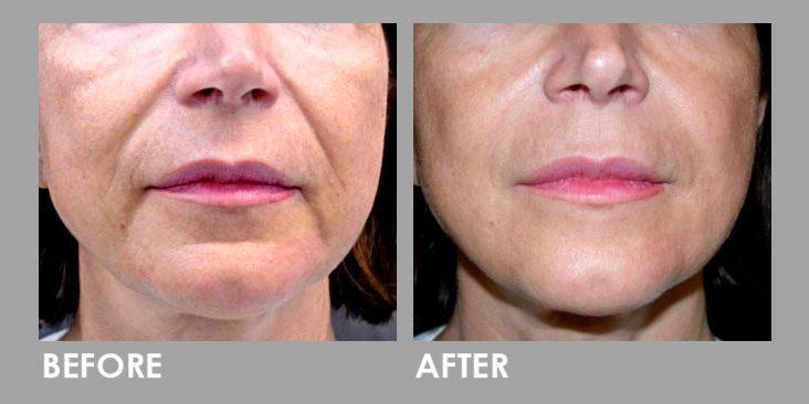 PRP Therapy Before After