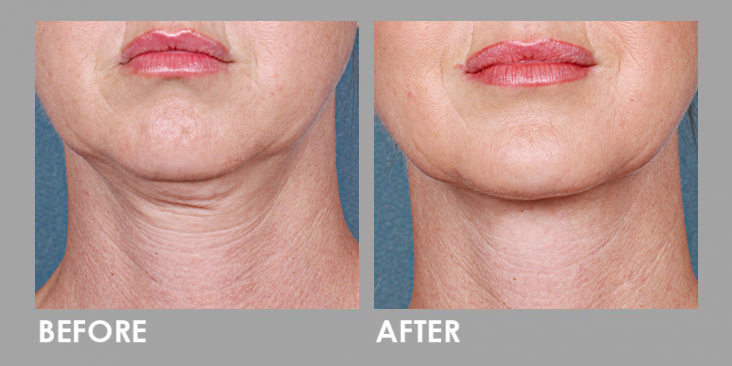 Prp Facial Treatment Before And After