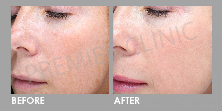 Carbon Laser Peel before and after