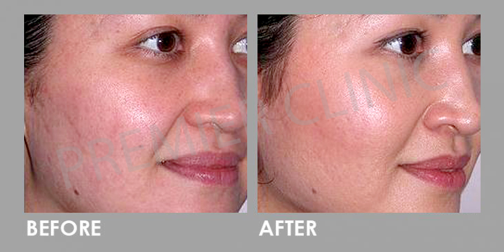 Carbon Laser Peel before and after