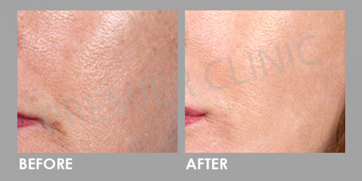 Carbon Laser Peel before and after