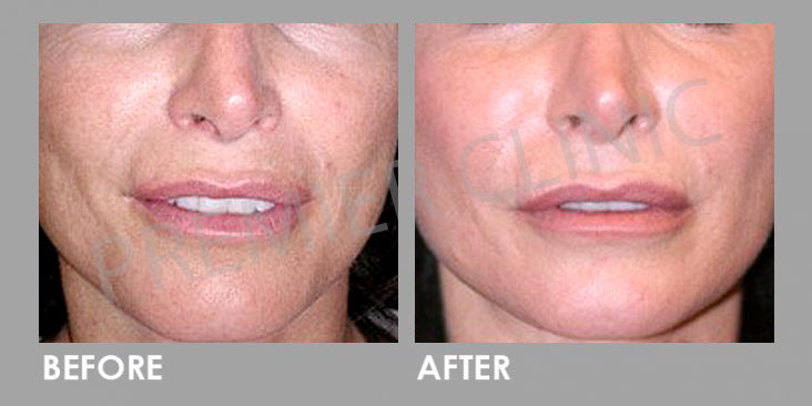Mesotherapy Before After