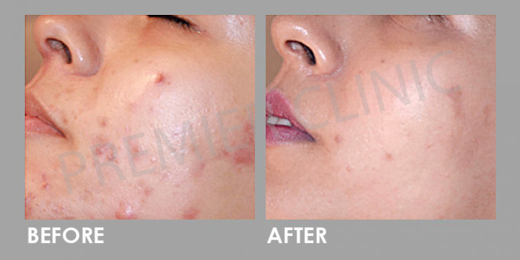 Mesotherapy Before After