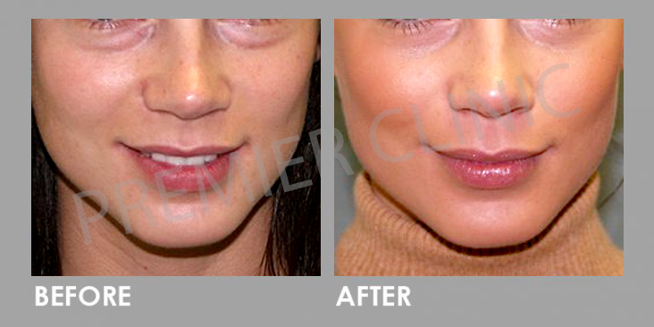 PRP Therapy Before After