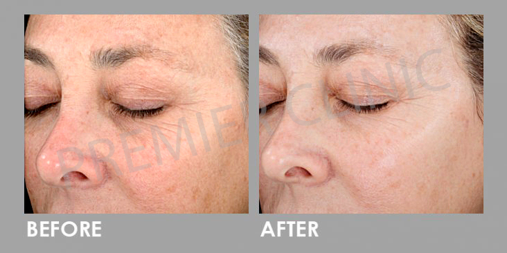 SilkPeel Dermalinfusion Before After