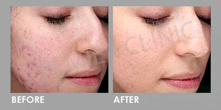 Skin Peel before and after