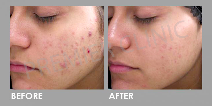 Skin Peel before and after