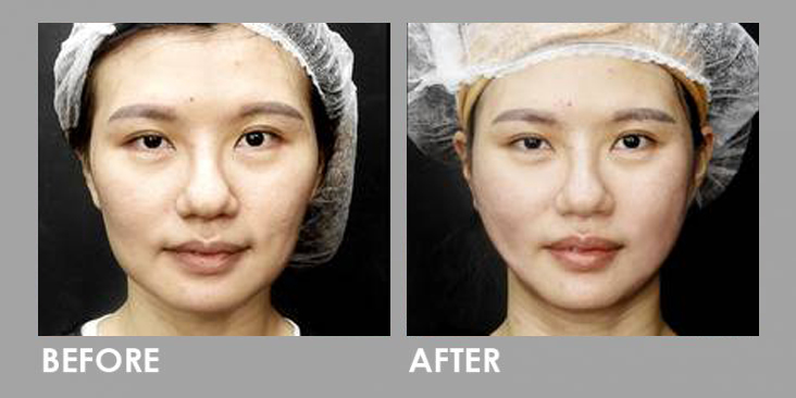 Threadlift skin tightening