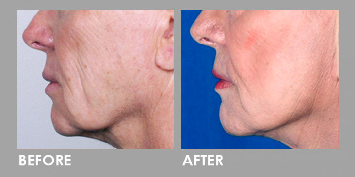 Threadlift skin tightening