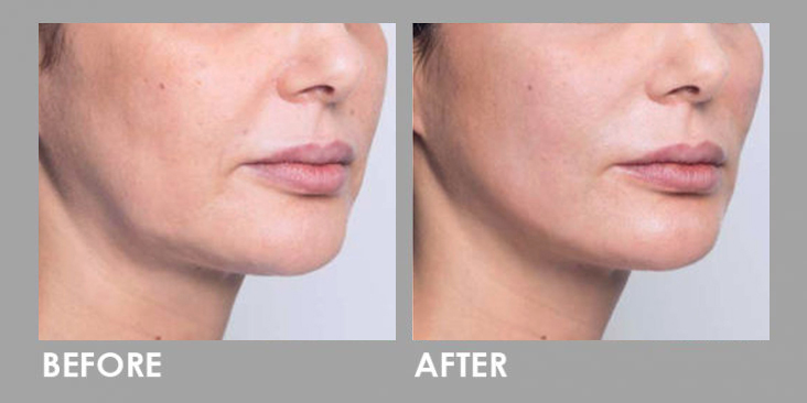 Threadlift skin tightening