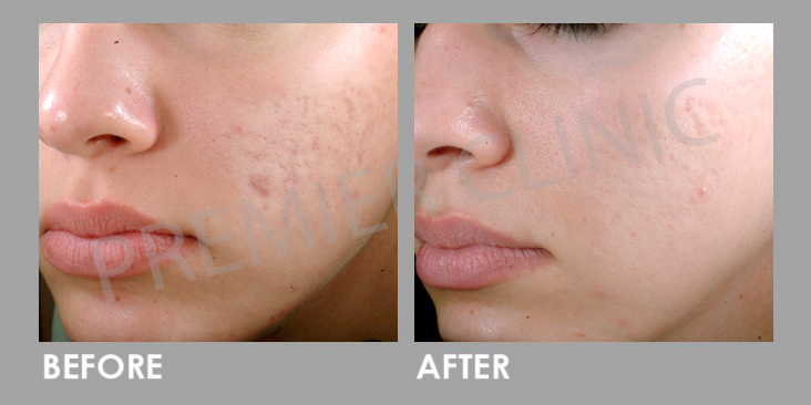 pmd microderm before and after