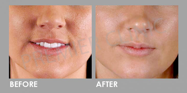 microdermabrasion before and after