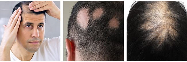 Hair loss Symptoms