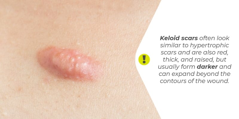 Keloid-scars