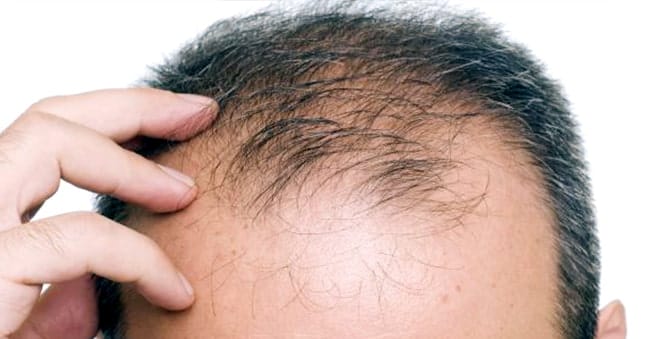 Treatment Available for Hair Loss