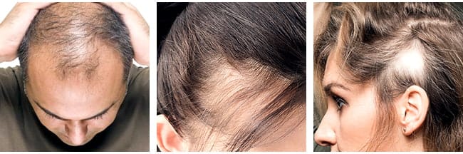 Types of Hair Loss