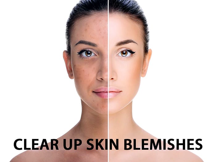 Clear up skin blemishes