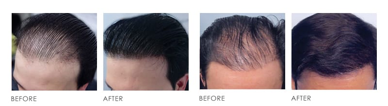 Hair Transplaint Before After