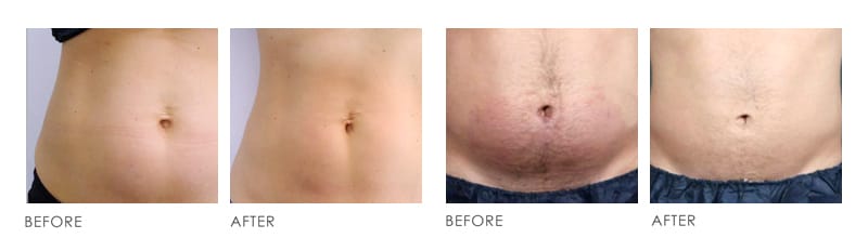 Premier belly freeze Before After 