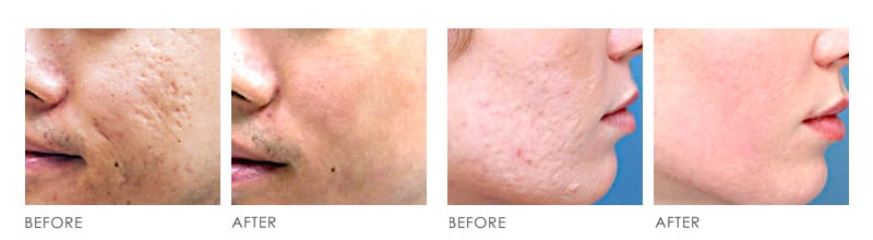 SKIN RESURFACING Before After