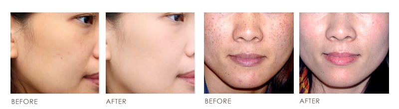 SKIN WHITENING Before After