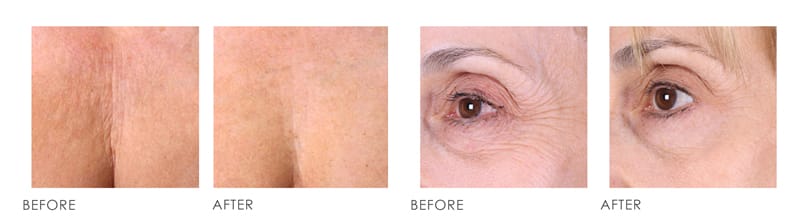 Ultherapy Before After