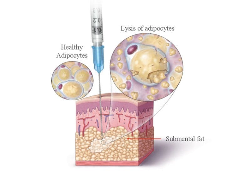fat-dissolving-injection