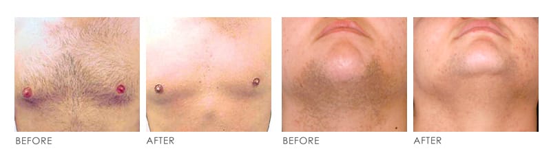 laser hair removal Before After 01